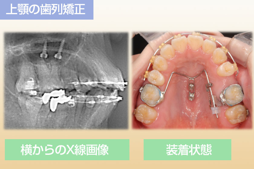 上顎の歯列矯正事例